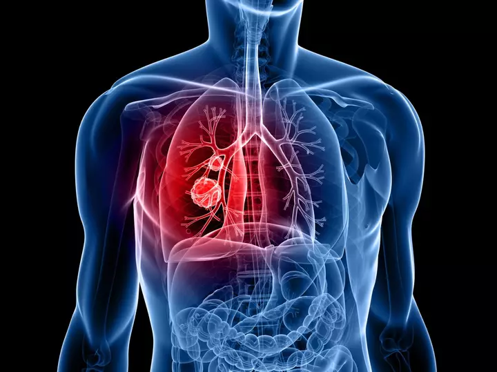 New Blood Test Can Find One of the Deadliest Cancers Returning—Before Scans