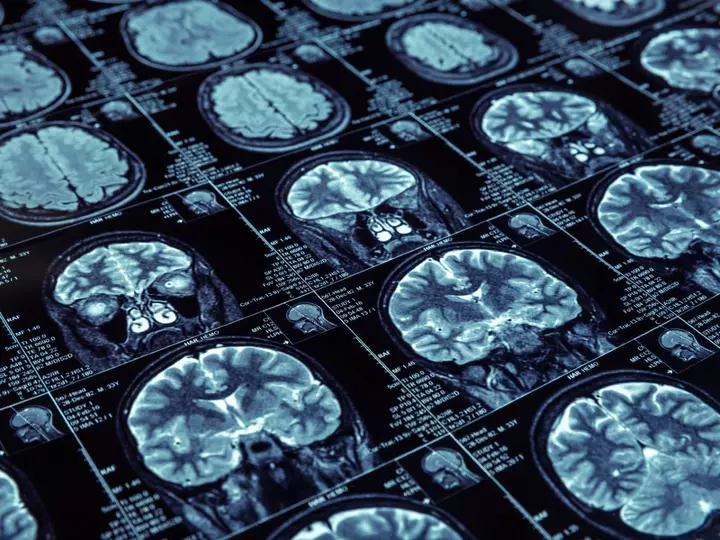 Scientists Investigated People With Insomnia. A Health Risk Pattern Emerged