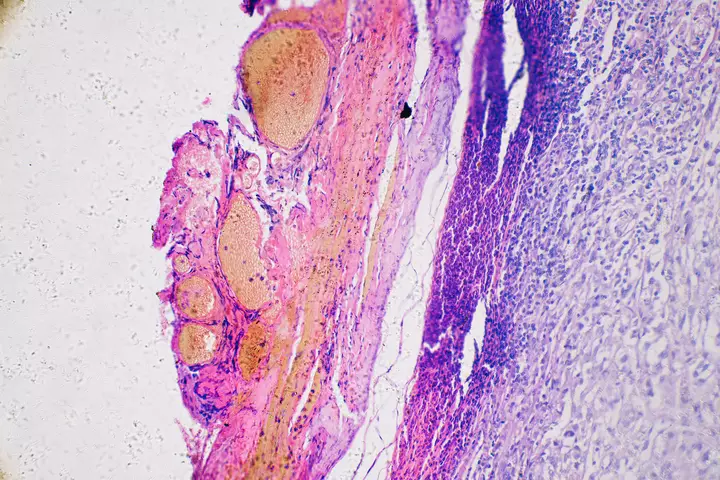 A Personalized Cancer Vaccine Lowers Melanoma Recurrence by 42%